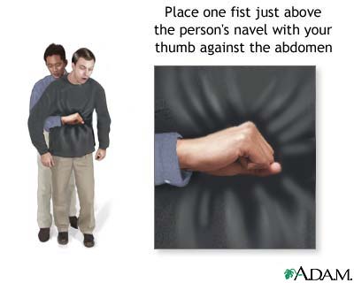 Heimlich maneuver on adult