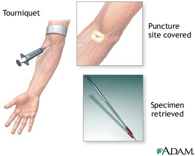 Procedure