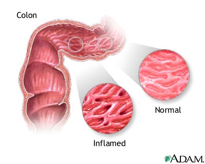 Indications