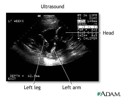 Ultrasound, normal fetus- ventricles of brain