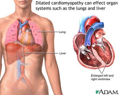 Dilated cardiomyopathy