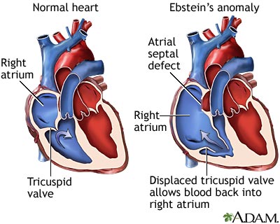 Ebstein's anomaly