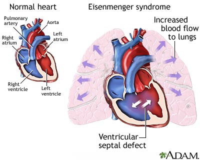 Eisenmenger syndrome