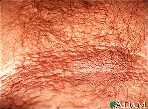 Acanthosis nigricans - close-up