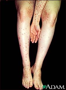 Dermatitis, herpetiformis on the arm and legs