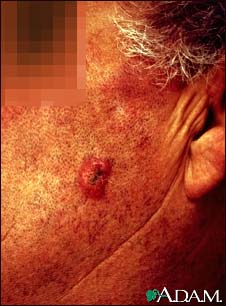 Squamous cell carcinoma - invasive