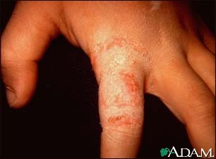 Ringworm, tinea manuum on the finger