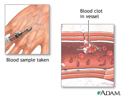 Blood clots