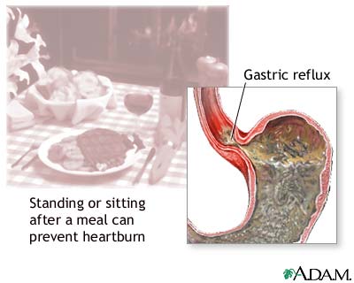 Heartburn prevention