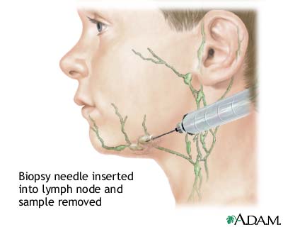 Lymph node culture