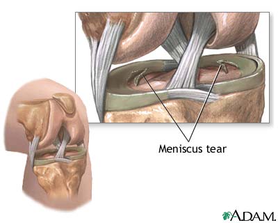 Meniscal tears