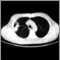 Lung with squamous cell cancer - CT scan