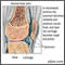 Rheumatoid arthritis