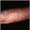 Actinic keratosis on the arm