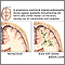 Leukoencephalopathy