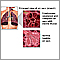 COPD (Chronic Obstructive Pulmonary Disorder)