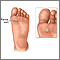 Plantar wart