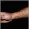 Sporotrichosis on the hand and arm