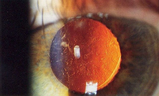 File:Posterior capsular opacification on retroillumination.jpg
