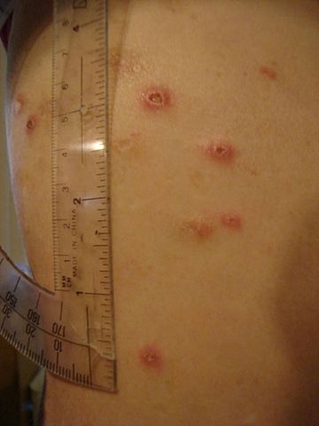 File:Crohnie sores 4.JPG